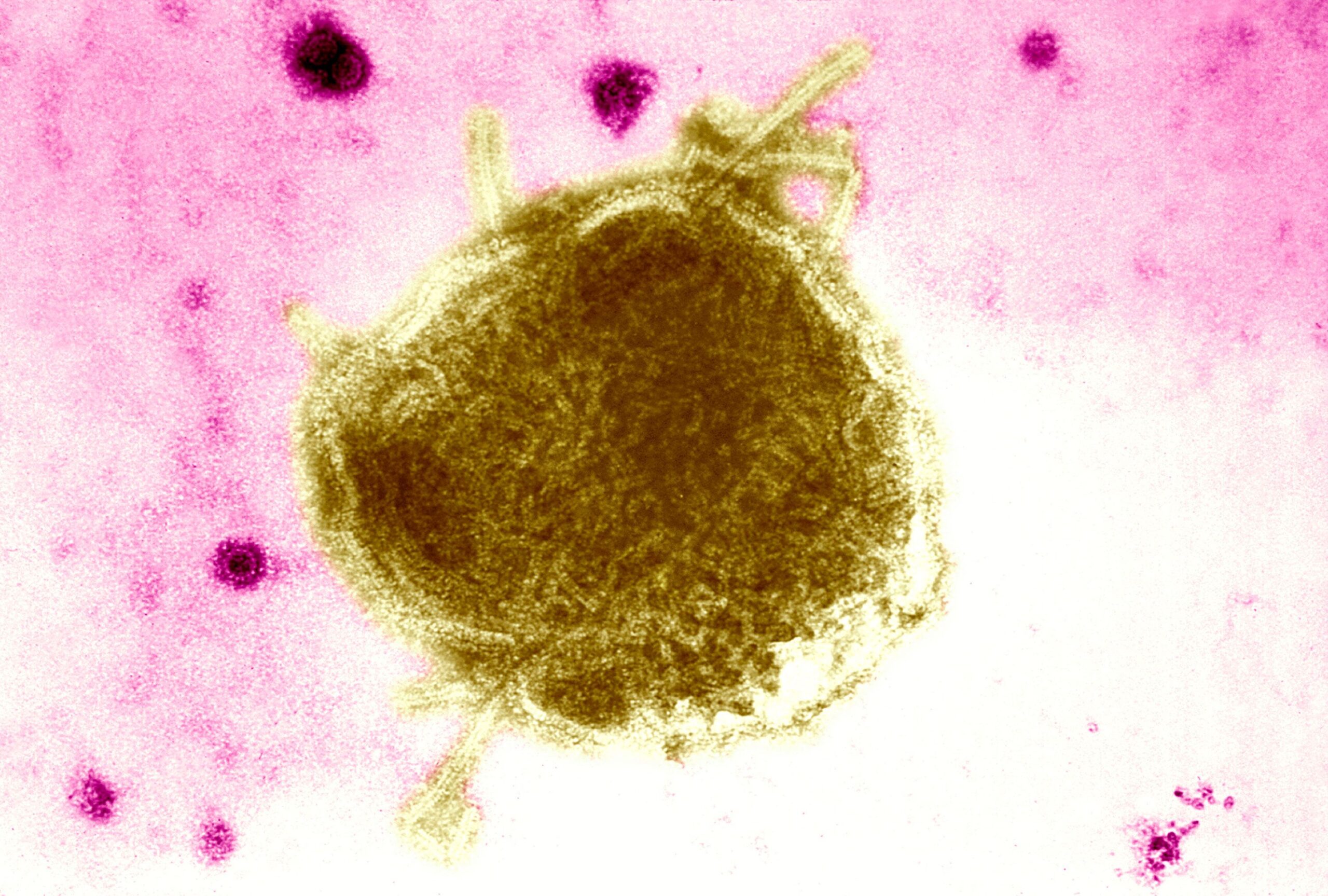 <i>BSIP/Universal Images Group/Getty Images via CNN Newsource</i><br />The number of confirmed measles cases reported in an outbreak in West Texas is now at 124