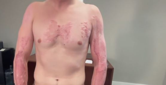 <i>KNXV via CNN Newsource</i><br/>A man who suffered third-degree burns across much of his body after Phoenix officers pinned him face down on the scorching hot pavement has filed a federal lawsuit against the city.