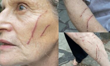 Katharine VanBuskirk says she was attacked by a raccoon over the weekend while letting her dogs out in a community yard.