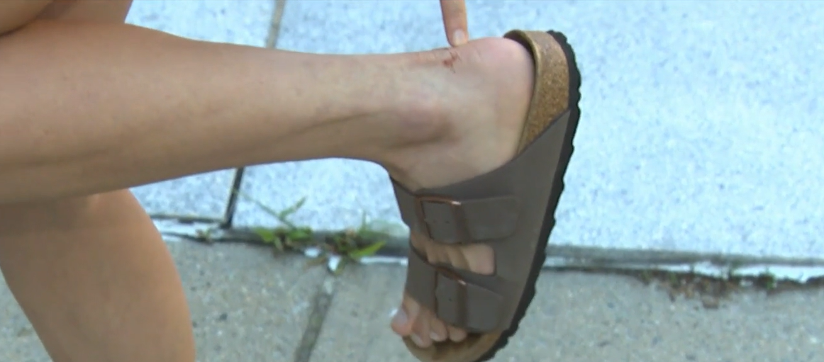 <i>WBZ via CNN Newsource</i><br/>Min Namgung claims to have been bitten by a rat while she was walking down Mountfort Street in the Fenway area on August 1.