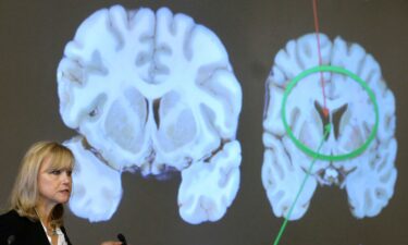 Research from Dr. Ann McKee of Boston University and other scientists examined the brains of people with and without CTE.