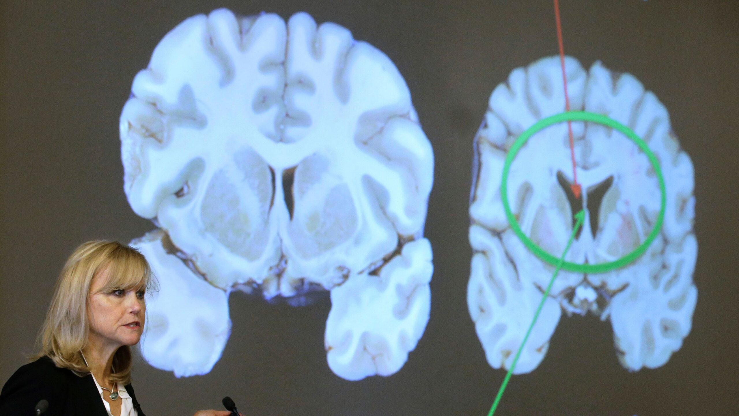 Research from Dr. Ann McKee of Boston University and other scientists examined the brains of people with and without CTE.