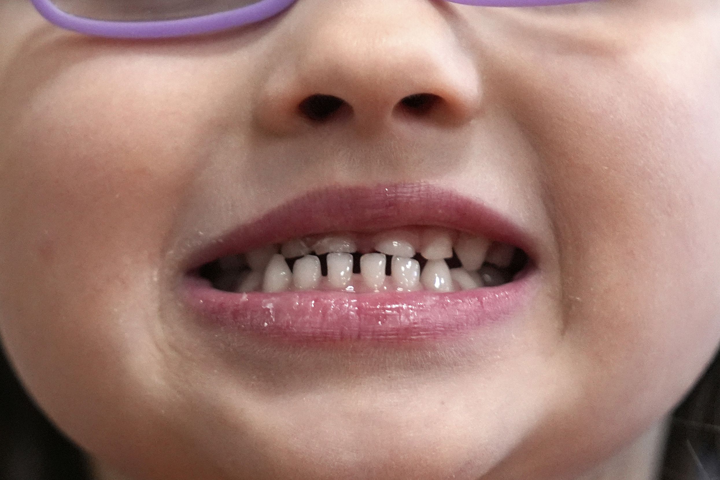 <i>Robert F. Bukaty/AP via CNN Newsource</i><br/>The FDA says fluoride supplements “should not be used in children under age 3 or by older children who are not at high risk of tooth decay.”