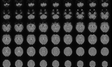 Functional magnetic resonance imaging (fMRI) is a non-invasive technique that measures brain activity. This fMRI image shows multiple horizontal views of the brain