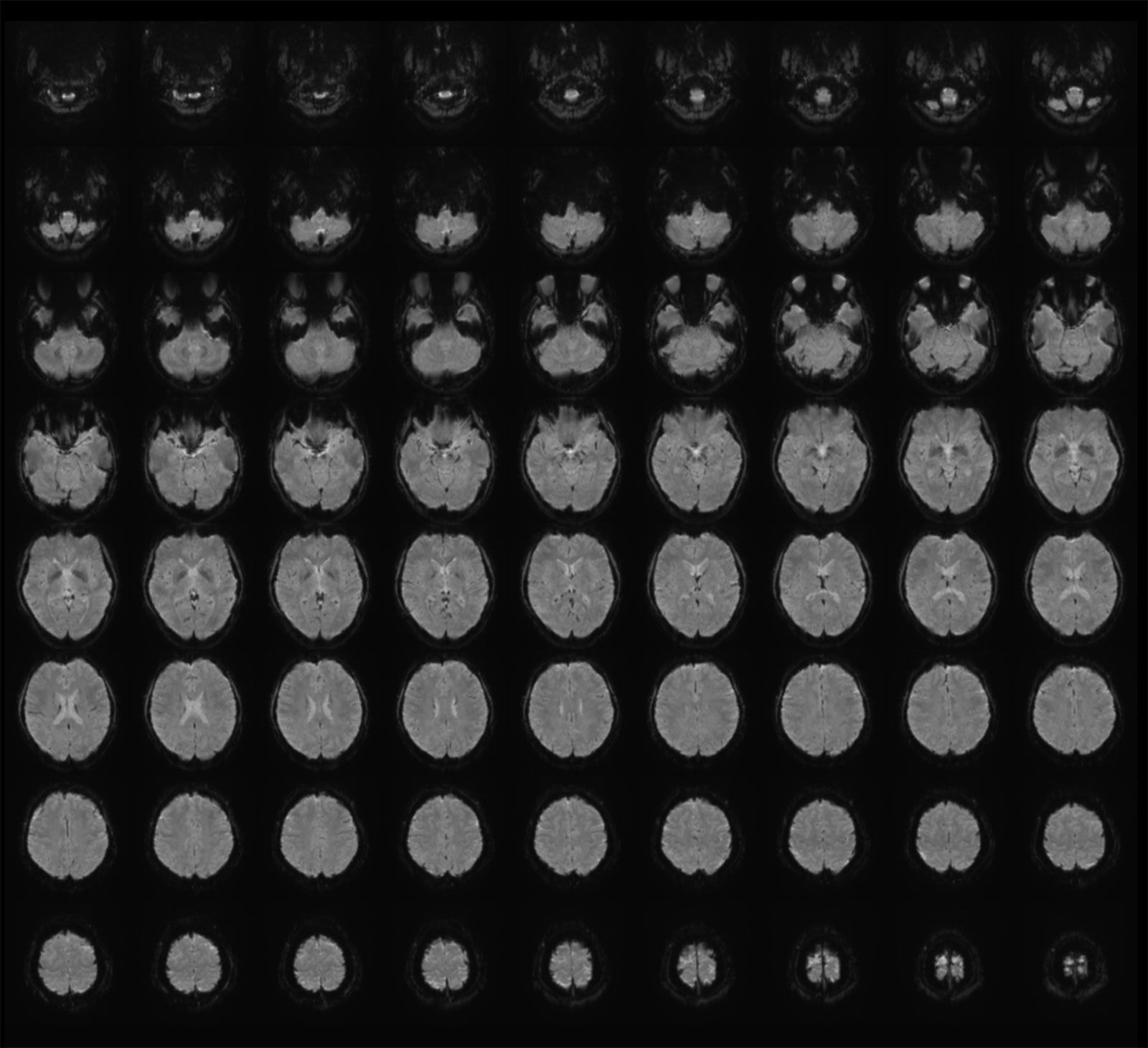 <i>Tomoyasu Horikawa via CNN Newsource</i><br/>Functional magnetic resonance imaging (fMRI) is a non-invasive technique that measures brain activity. This fMRI image shows multiple horizontal views of the brain