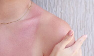 Heat rash vs. sunburn: How to tell the difference and when it's neither