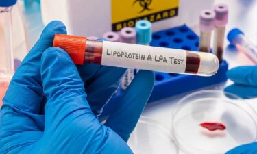 1 in 5 people may have this hidden genetic stroke risk