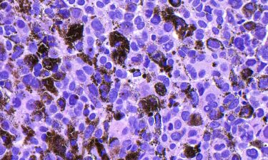 Merck and Moderna released results of a late-stage trial that showed an experimental mRNA vaccine slashed the risk that melanoma returns by 42%.